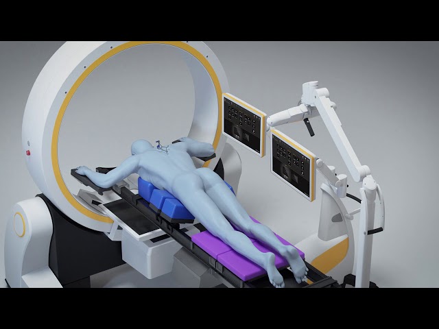 Loop-X®